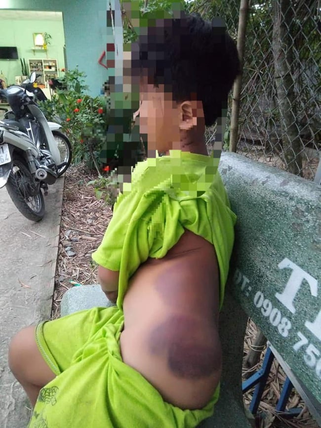 Bé K. bị cô giáo đánh bầm tím trên Sh88bet đăng ký miễn phí