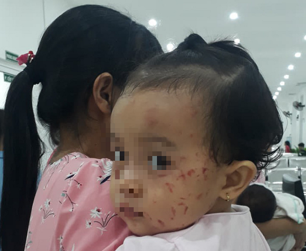 Gương mặt nhiều vết trầy xước của bé gái.