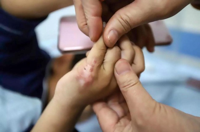 Một phần tay bị bỏng của nạn nhân.