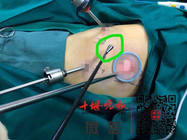 Trong phế quản phải của Tiểu Học có một dị vật hình nón bị mắc kẹt.