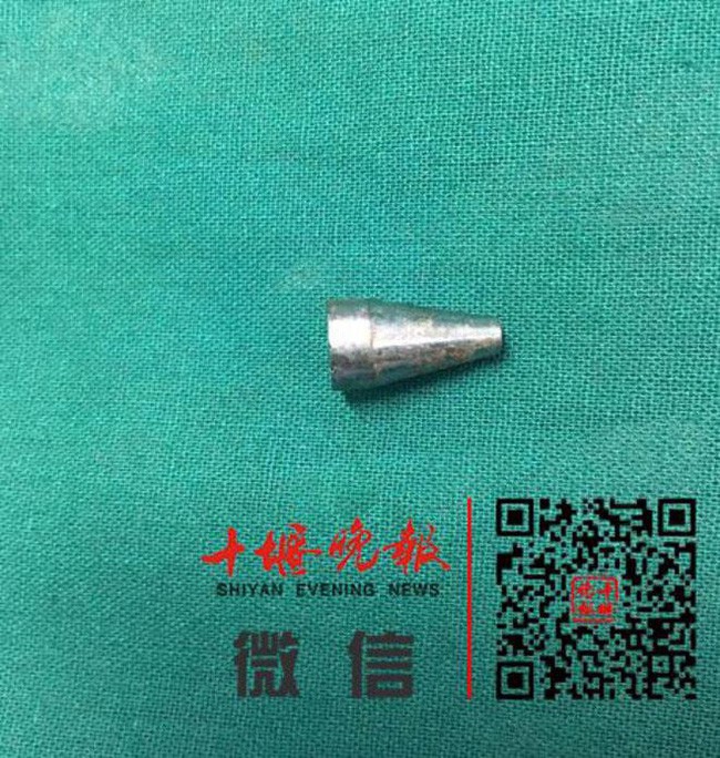 Dị vật được các bác sĩ lấy ra khỏi Sh88bet đăng ký miễn phí cô bé.