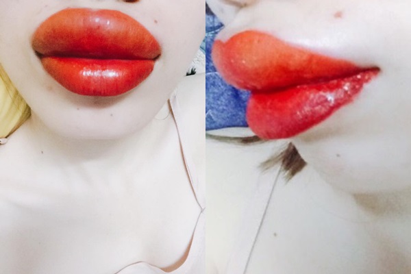 Cô gái đau đớn nhận về đôi môi sưng to, ở góc nghiêng còn đáng sợ hơn.