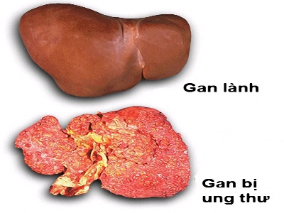 ung-thu-gan-sharoncuneta.com