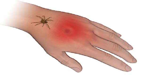 spider-bites
