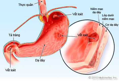 nguyen-nhan-gay-viem-da-day