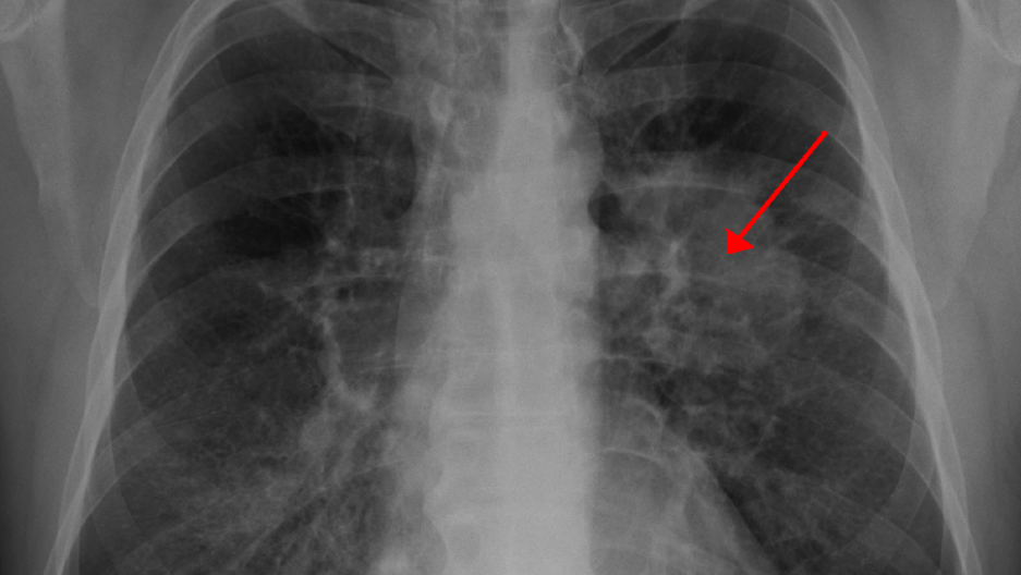 lungcacxr