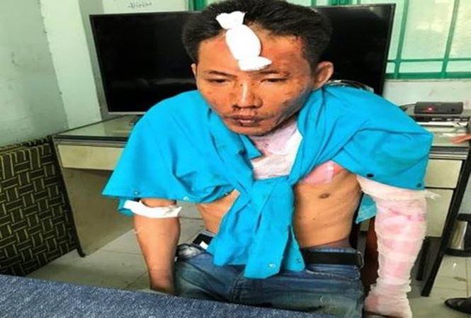 Nghi can Nguyễn Quang Dũng cũng bị bỏng nhẹ sau vụ việc