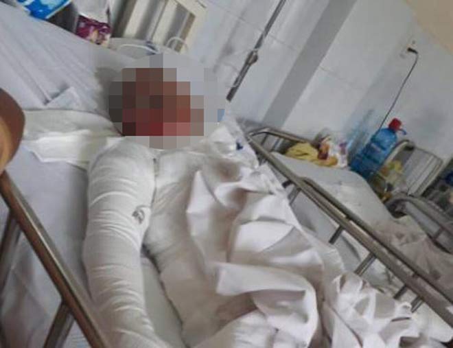 Bị chồng tẩm xăng thiêu sống, tính mạng chị H. như ngàn cân treo sợi tóc. Ảnh: HL