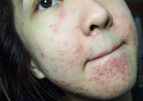 PrettyTips-kich-ung-da