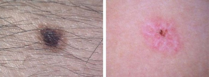 Bên trái là nốt ruồi khỏe mạnh, bên phải là hình nốt ruồi có đường viền mờ.