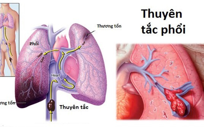 thuyen-tac-phoi17442-152963557352462665146