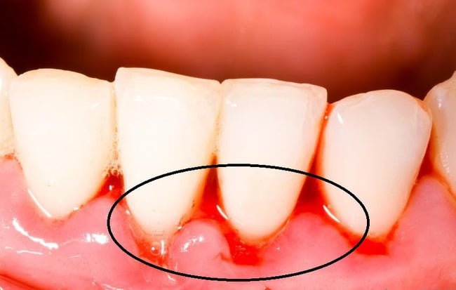bleeding-gums-1512463032317-0-93-547-973-crop-1512463044164