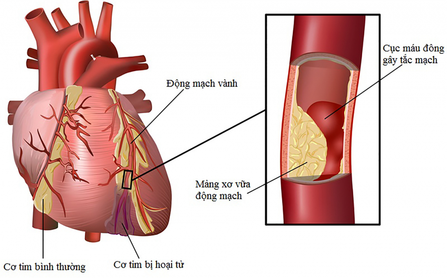 loi-ich-cua-tam-that-bac-voi-benh-dong-mach-vanh
