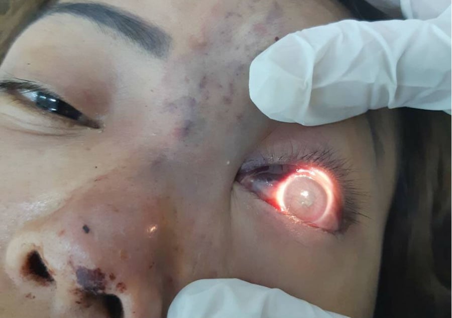 Tiểu Trần ngủ dậy và phát hiện mắt bị mù
