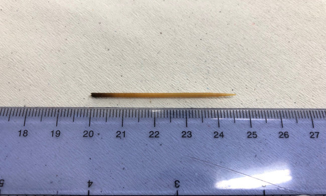 Dị vật là chiếc tăm dài 5cm được lấy ra sau đó.    