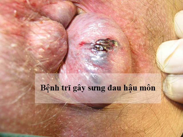trieu-chung-benh-tri-5.jpg.pagespeed.ce.dgz3SAi73r