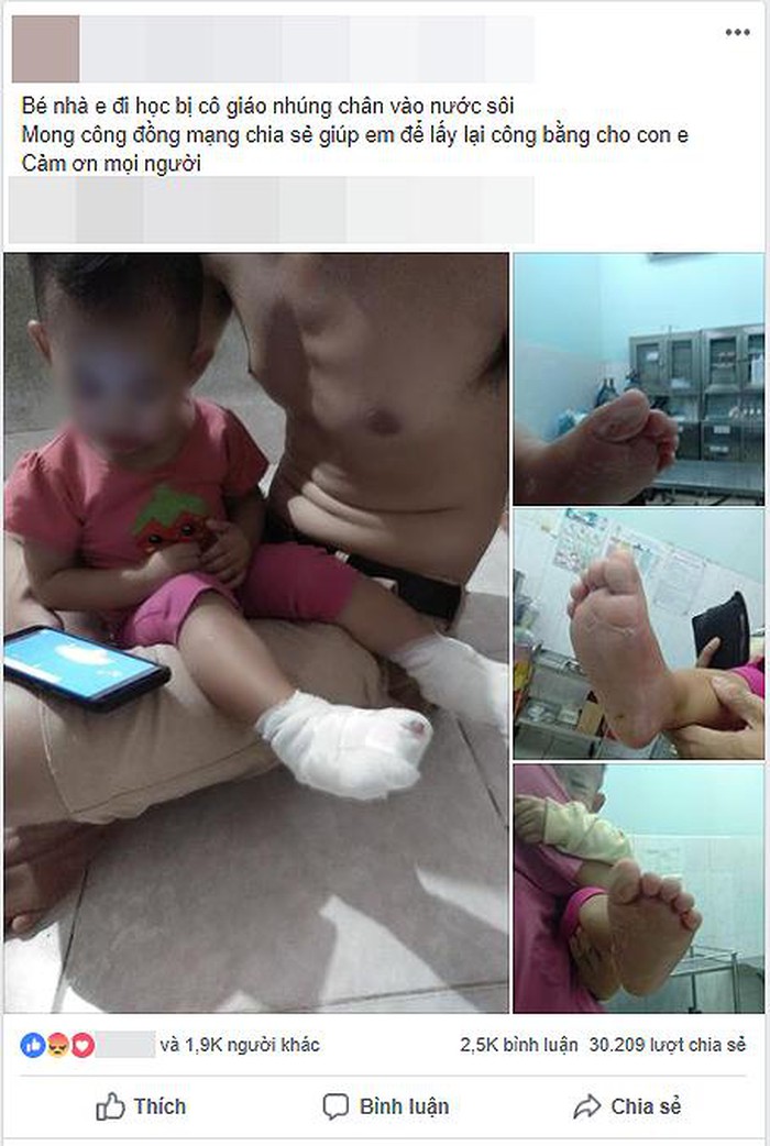 Chia sẻ của phụ huynh khi biết con mình bị bỏng do bảo mẫu mở nhầm nước nóng