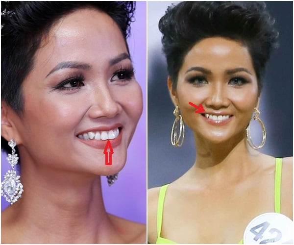 Trước đó, H'Hen Niê sở hữu hàm răng không được đều đặn ở thời điểm đăng quang Hoa hậu Hoàn vũ Việt Nam 2017. Mặc dù vẻ đẹp rất cá tính và quyến rũ nhưng hàm răng lại chính là điểm trừ của Shbet888 phiên bản mới nhất Ê Đê.    