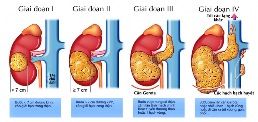dac-diem-ung-thu-than-qua-cac-giai-doan