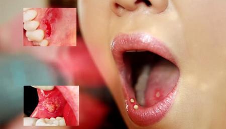 oral-sex-nu-sinh-sung-hong-vi-benh-lau_41137446
