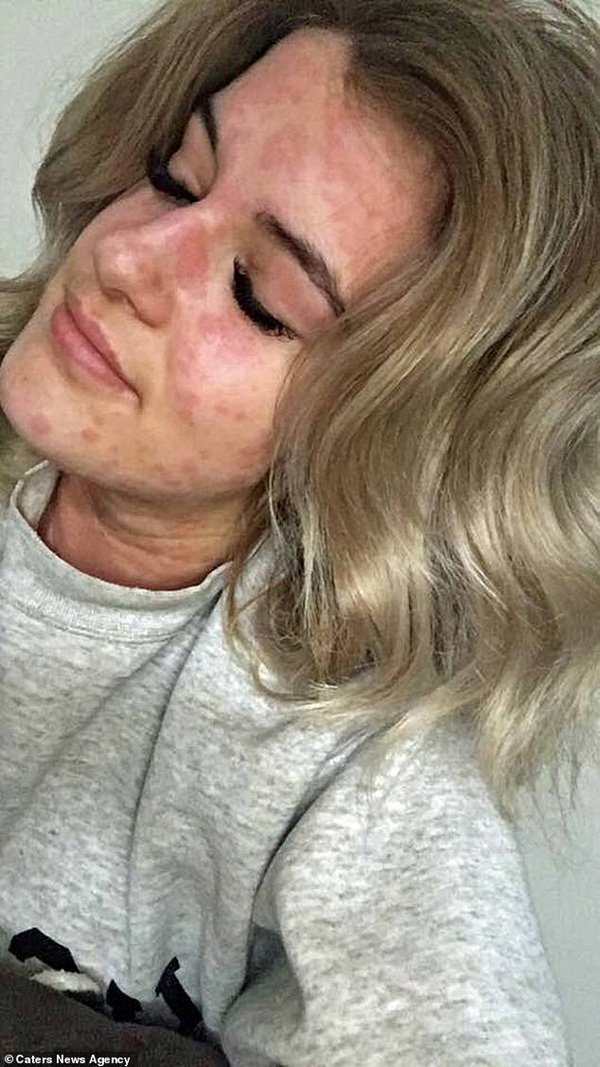 Cơ thể Arianna thường xuyên nổi mề đay từng mảng rất lớn, sưng và ngứa. Arianna có thể không được chữa khỏi hoàn toàn, mà chỉ uống thuốc làm giảm nhẹ các phản ứng.    
