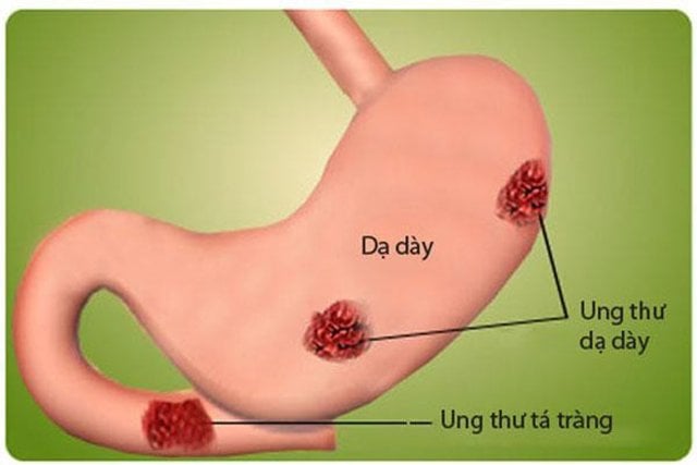 ung-thu-da-day