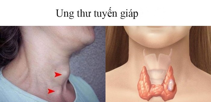 nguoi-phu-nu-mac-ung-thu-o-tuoi-31-vi-sai-lam-ma-nhieu-nguoi-mac-phai-33581a