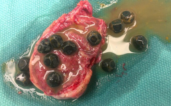 gallstones-with-pus-770x430-1479650596058-0-27-430-720-crop-1479650604980