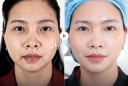 Căng da không Shbet888 tiền thưởng cực khủng -Công nghệ 5.5.10: Vì sao trở thành xu hướng trẻ hóa được phụ nữ sau 40 tuổi lựa chọn?