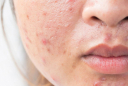 Muốn ngăn mụn tái phát? Đừng bỏ qua 6 bước chăm sóc da giúp duy trì Mừng SHBET phiên bản mới 2025 khỏe mạnh