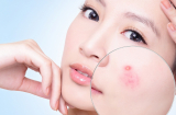 Dùng cả thanh xuân để trị mụn nhưng vẫn chưa thành công vì 5 lý do này