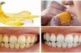 Giữ lại vỏ chuối và làm theo hướng dẫn này đảm bảo mảng bám, ố răng sẽ 'Biến mất ngay lập tức'