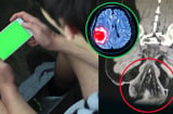Cái giá đắt cho việc vừa đi vệ sinh vừa chơi điện thoại nhẹ cũng tai biến mạch máu não, nặng thì mất mạng