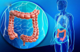 Uống 1 lon nước ngọt mỗi ngày, ung thư xuất hiện sớm, ác tính hóa nhanh, nội tạng bị huỷ hoại trầm trọng