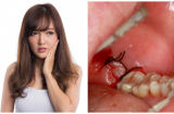 4 thời điểm 'độc' tuyệt đối không được nhổ răng kẻo mang vạ vào thân, nguy hiểm ập đến bất ngờ