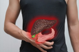 Cảnh báo từ vụ: Người đàn ông trẻ bị ung thư gan, đây là thói quen mà bác sĩ khuyến cáo phải bỏ ngay