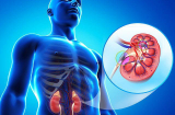 5 loại thực phẩm phổ biến gây rối loạn thận nếu ăn quá nhiều