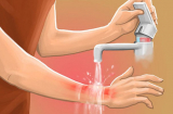 Sai lầm tai hại khi sơ cứu bỏng mà nhiều người vẫn lầm tưởng là đúng
