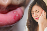 Cách chữa nhiệt miệng siêu hiệu quả mà không tốn một đồng
