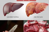 2 vợ chồng cùng mắc K gan, Bác sĩ chỉ ra “thủ phạm” ở trong chính mâm cơm nhà nào cũng có