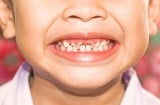 7 bệnh răng miệng thường gặp nhất ở trẻ, cha mẹ tuyệt đối không thể “làm ngơ”
