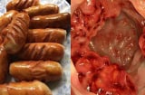 Cô gái 26 tuổi mắc bệnh vô phương cứu chữa, nguyên nhân đến từ loại thực phẩm giới trẻ đặc biệt yêu thích