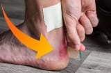 Thấy chân có xuất hiện 'điểm lạ' này thì nhanh đi khám ngay kẻo tắc mạch máu
