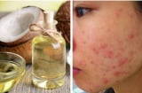 Lạm dụng dầu dừa rất nguy hiểm, đây là 5 tác hại mà chị em không thể chủ quan