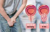 2 thói quen buổi sáng của nam giới khiến tuyến tiền liệt sinh bệnh, giữ 4 thói quen này để khỏe mạnh