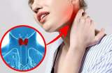 8 dấu hiệu cảnh báo sớm bệnh lý tuyến giáp, có 1 cũng không được chủ quan