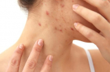 Chuyên gia cảnh báo: Người thức khuya thường có 3 điểm chung trên da, đây cũng là dấu hiệu gan không ổn chút nào