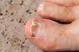 5 dấu hiệu trên bàn chân cảnh báo người tuổi thọ ngắn