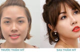 Dáng mũi cao nhẹ, tự nhiên với nâng mũi Tiny Point