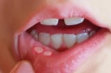 Thường xuyên viêm loét miệng không thể chủ quan, để lâu không khỏi rất dễ K miệng
